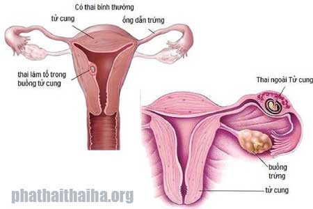 Nhận biết dấu hiệu mang thai ngoài tử cung