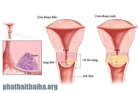 Nhận biết dấu hiệu ung thư cổ tử cung