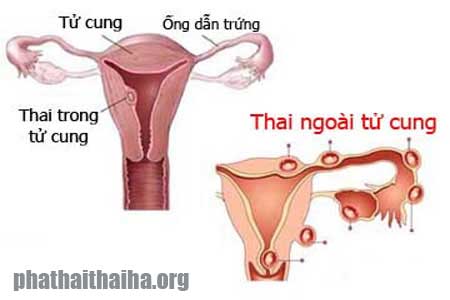 Thai ngoài tử cung là như thế nào?