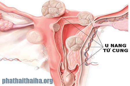 Bệnh u nang tử cung là gì?