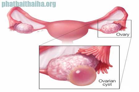U nang buồng trứng - Bệnh phụ khoa phổ biến