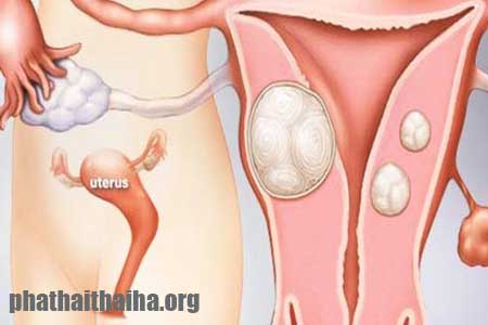 Bệnh u xơ tử cung thường gặp ở nhiều chị em